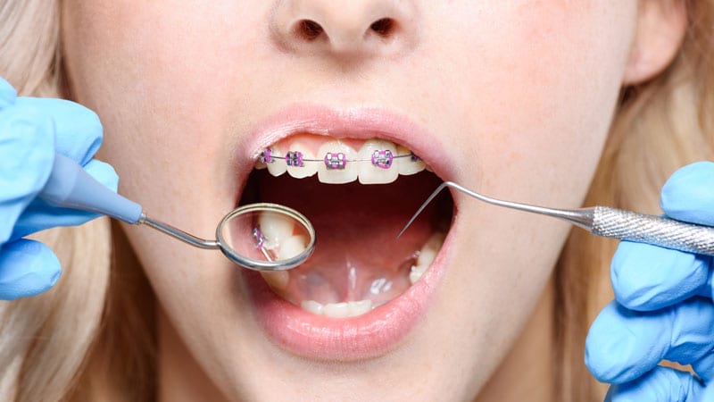 selecting the right braces colour in Singapore