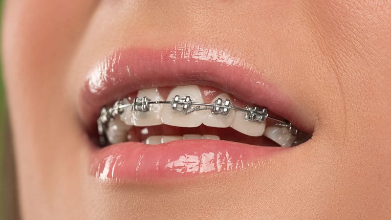 braces for special occasions