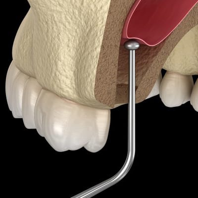 sinus-lifting-bone-grafts-in-singapore sinus lifting bone grafts in singapore