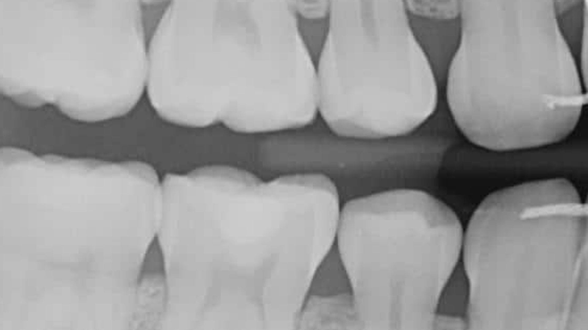 Bitewing-xray Bitewing Xray