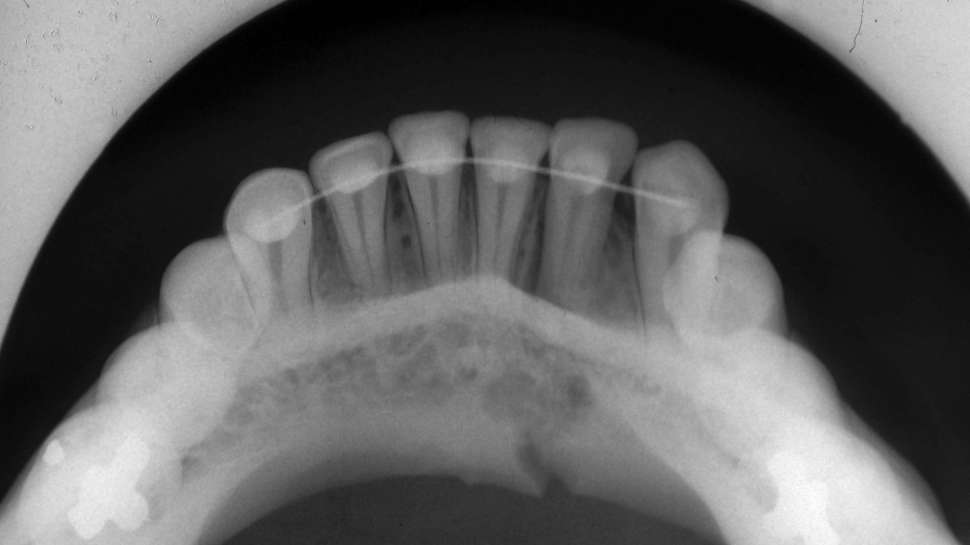 Occlusal-Xray-dental occlusal X Ray