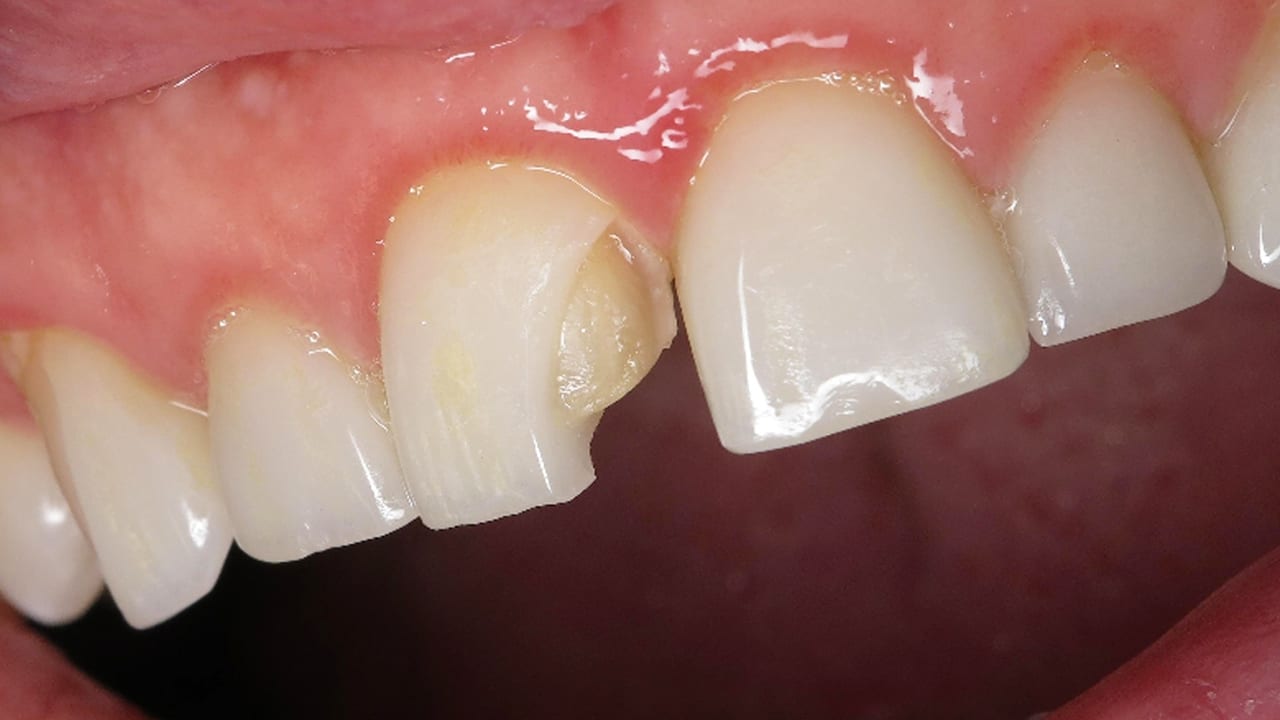 chipped tooth veneer