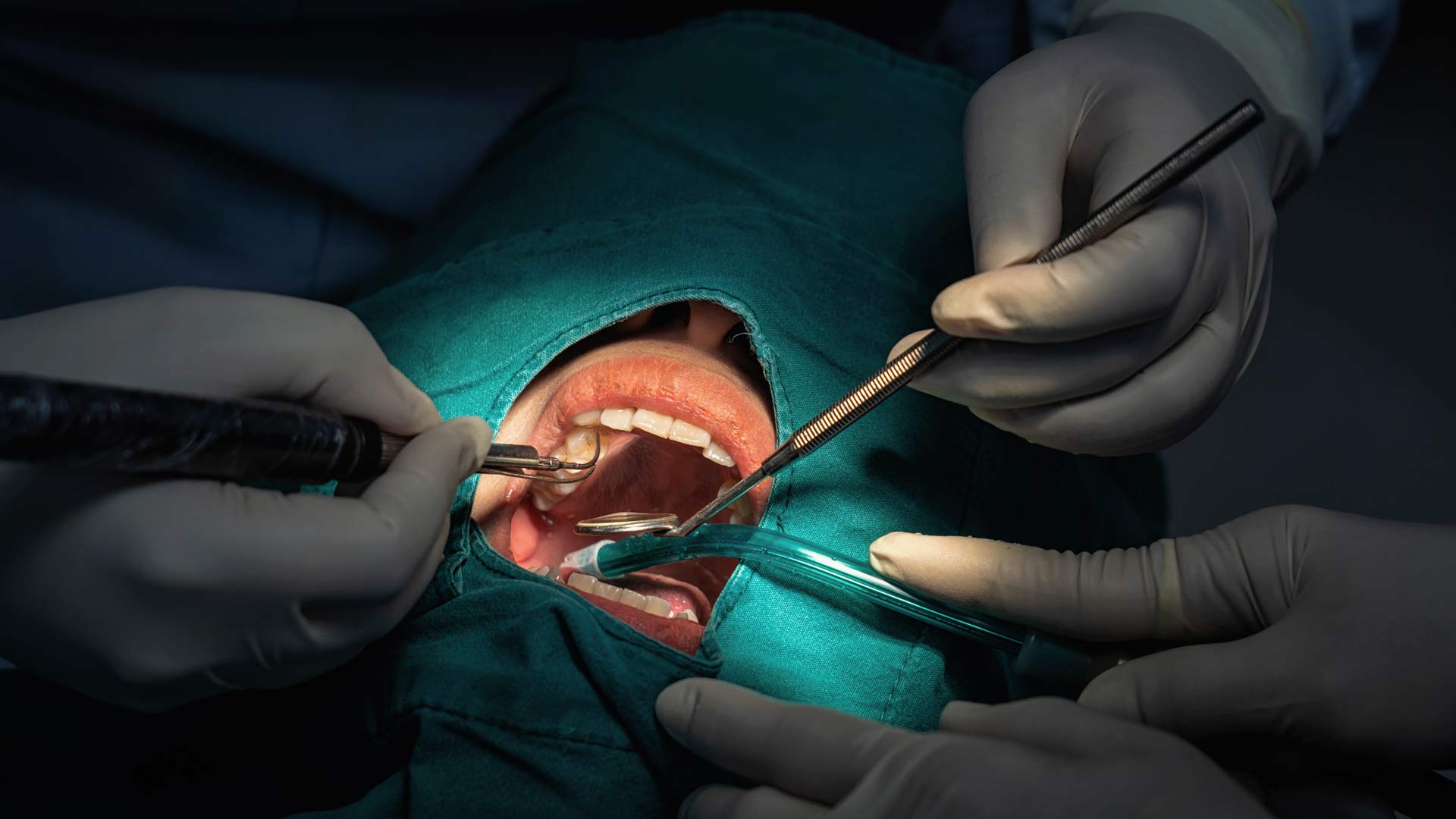 root canal treatment with dental dam