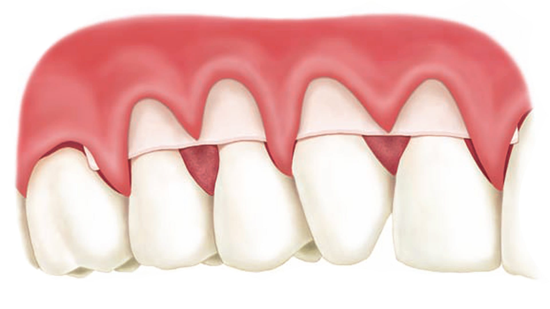 soft tissue gum graft