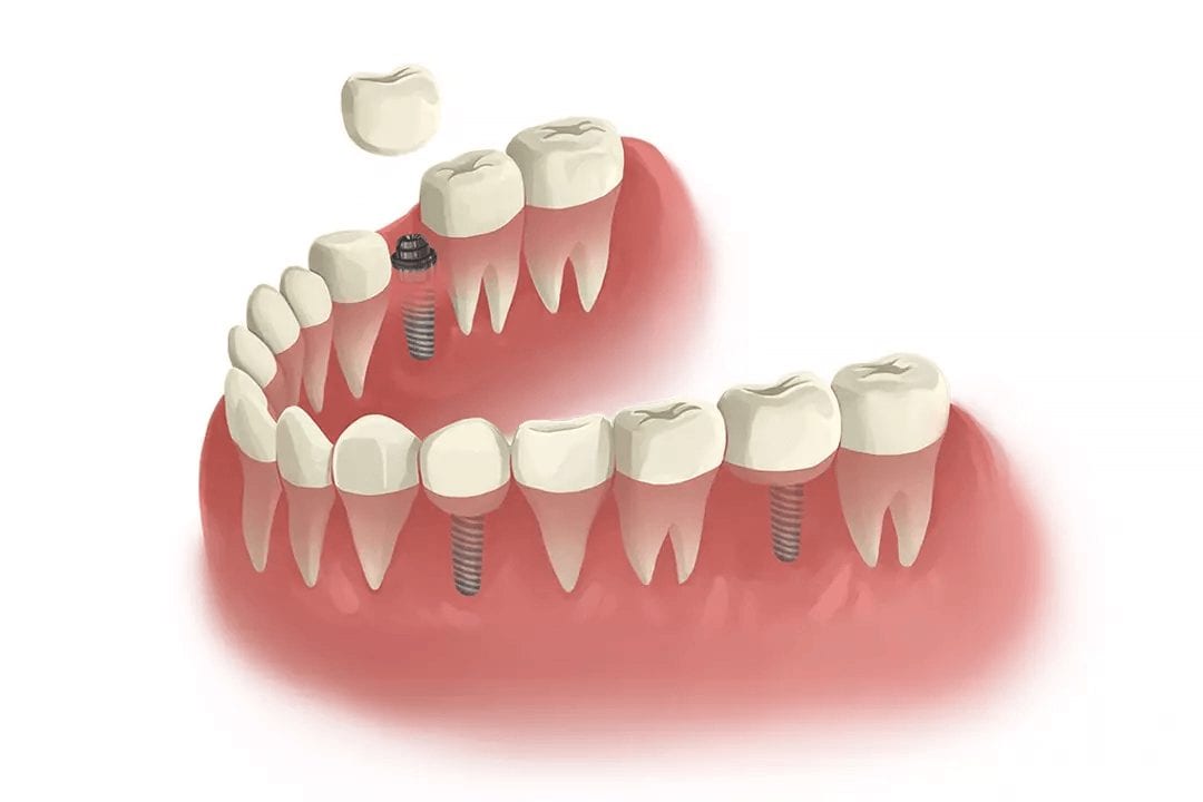 NoFrills-lp-dentalimplant-step5 multiple single tooth dental implants