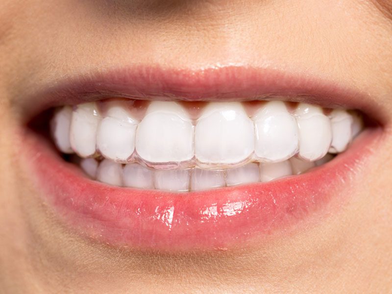 Close up of Invisalign clear aligners