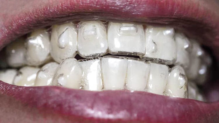 Attachments for Invisalign