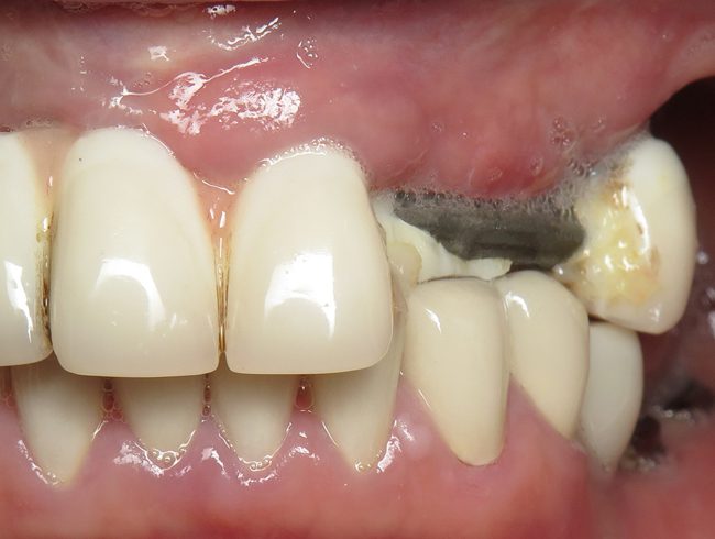 Broken-Bridge broken bridge