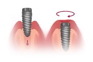 Dental implant fixture placement