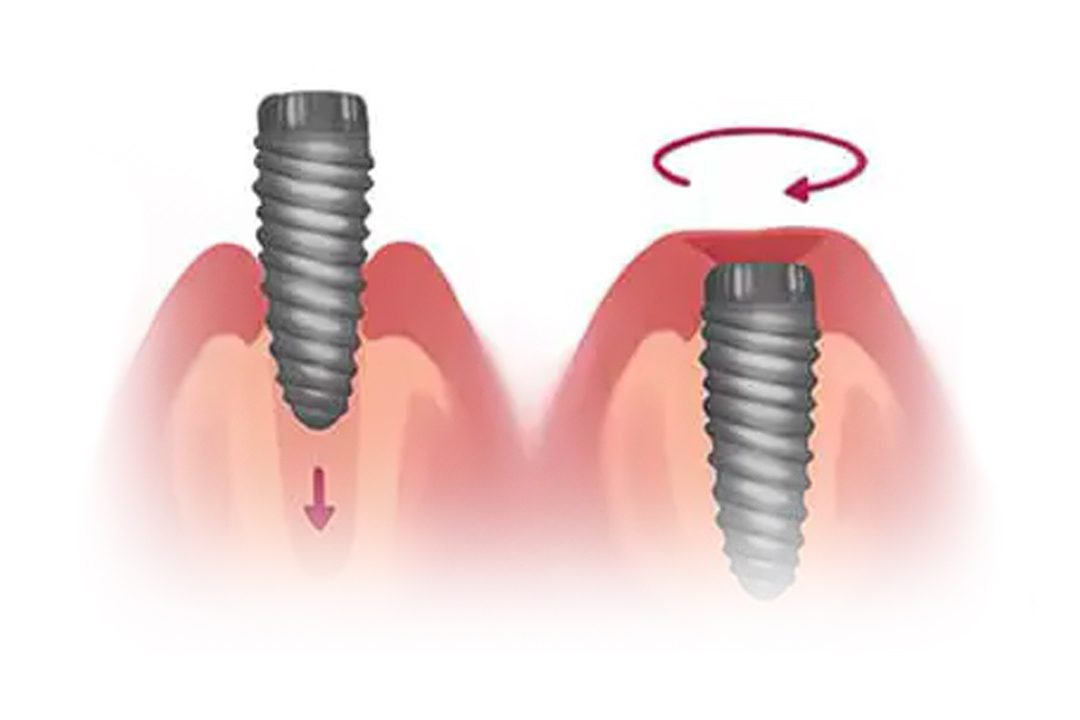 Dental implant fixture placement