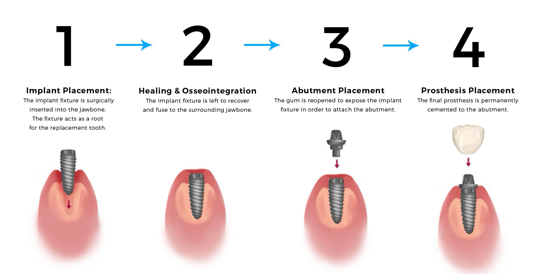 Full-Dental-Implant-Stages Dental implanting Stages