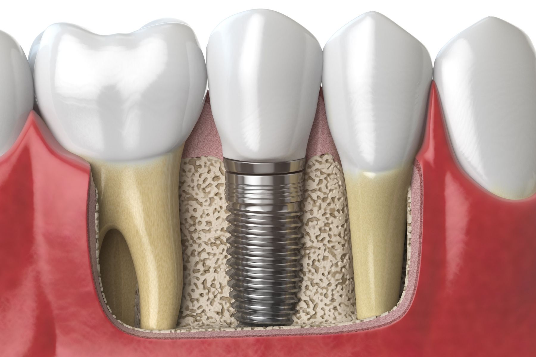 model of an implant tooth