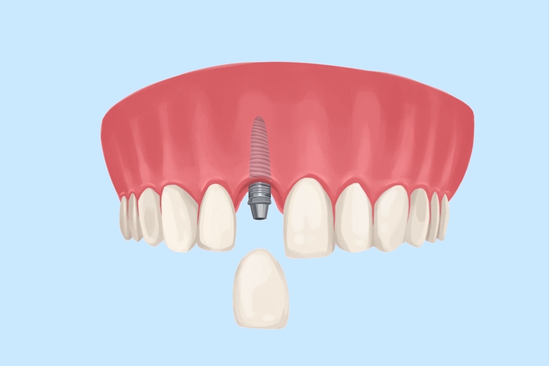 front teeth dental implant landscape front teeth dental implants