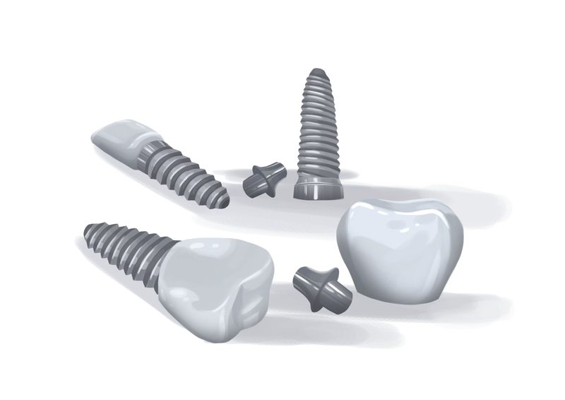 titanium implants
