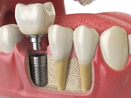 Anatomy of healthy teeth and tooth dental implant
