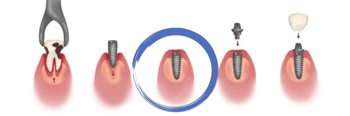 dental implant procedure with healing staged circled
