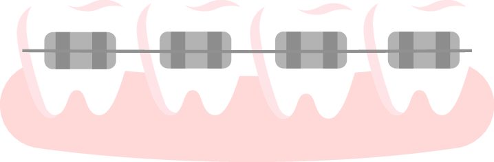 conventionalbraces woman suffering from implant allergy