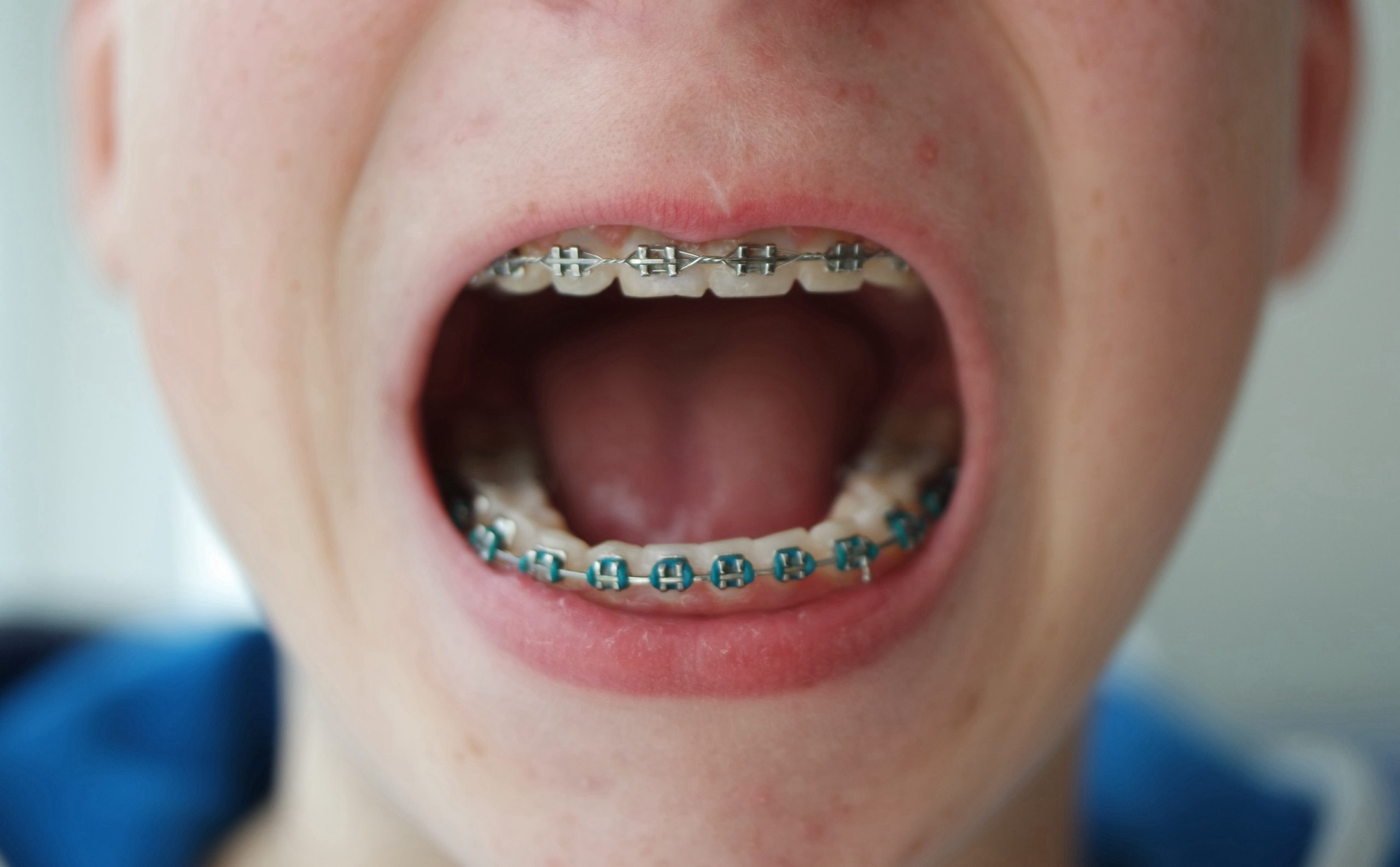 disadvantages of braces woman suffering from implant allergy