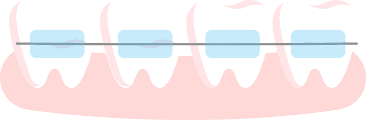 self-ligating braces woman suffering from implant allergy
