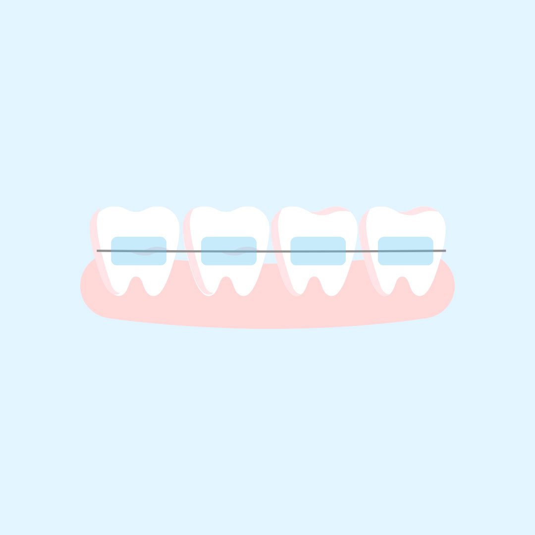ceramic-braces mobile ceramic braces