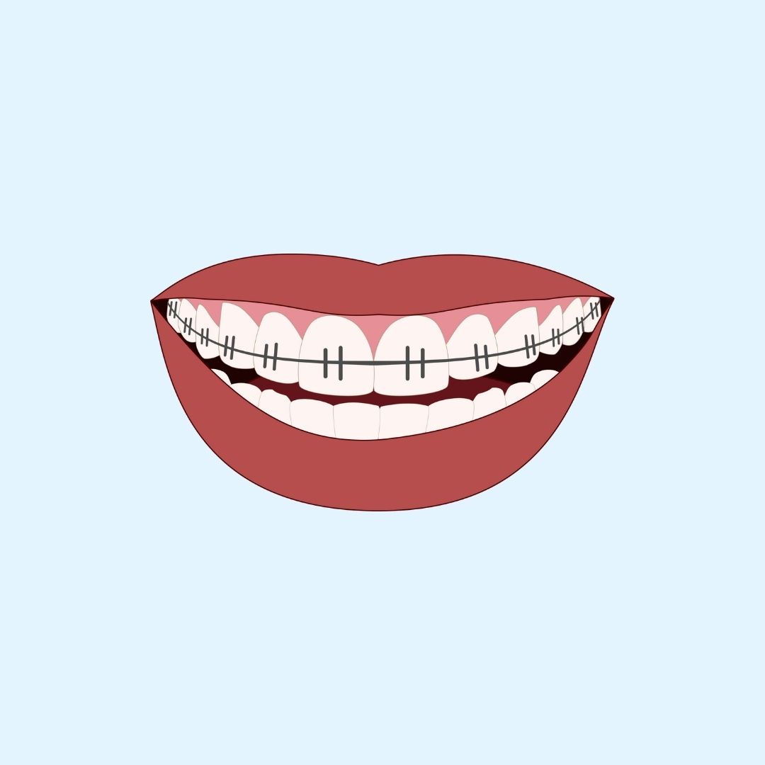 Your paragraph text self ligating braces