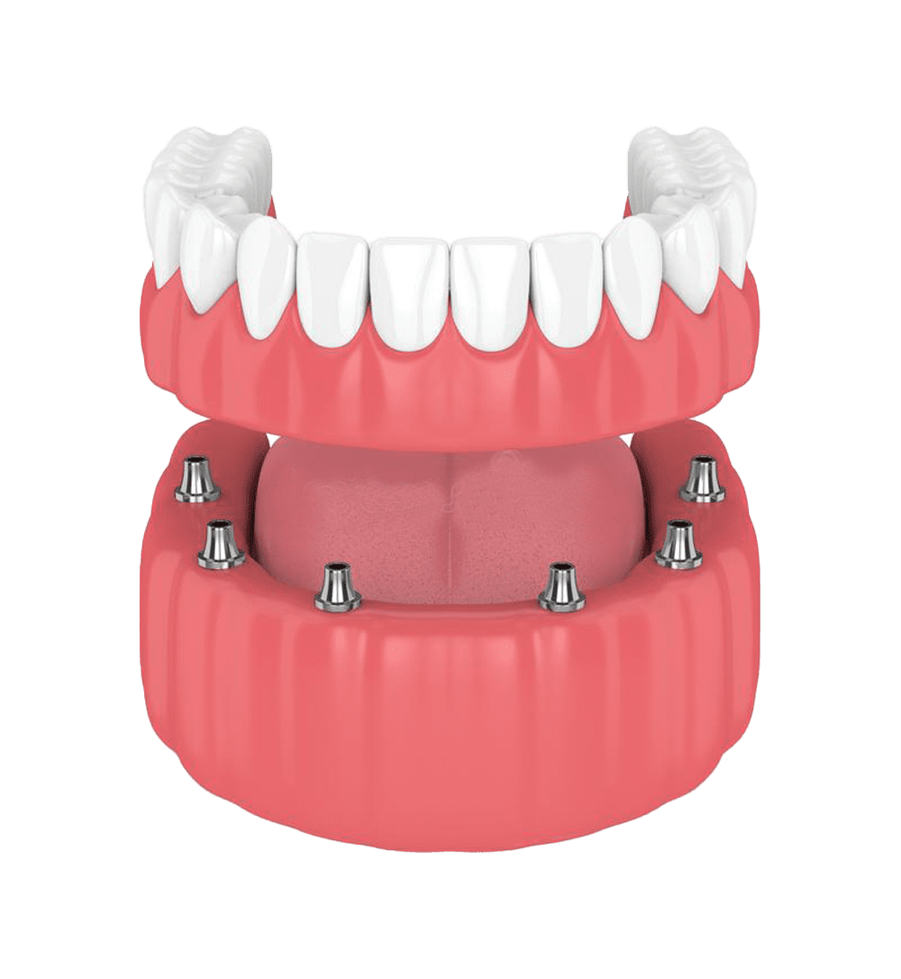 d-render-removable-full-implant-denture-d-render-removable-full-implant-denture-isolated-over-white-background-1180639981 Removable Dental Implant Overdenture