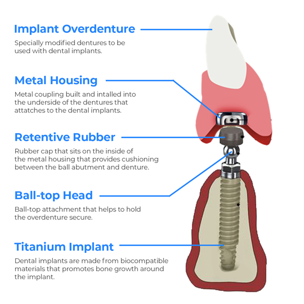 Overdenture-explained Overdentures explained