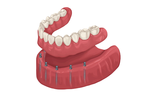 Overdenture-resized overdenture