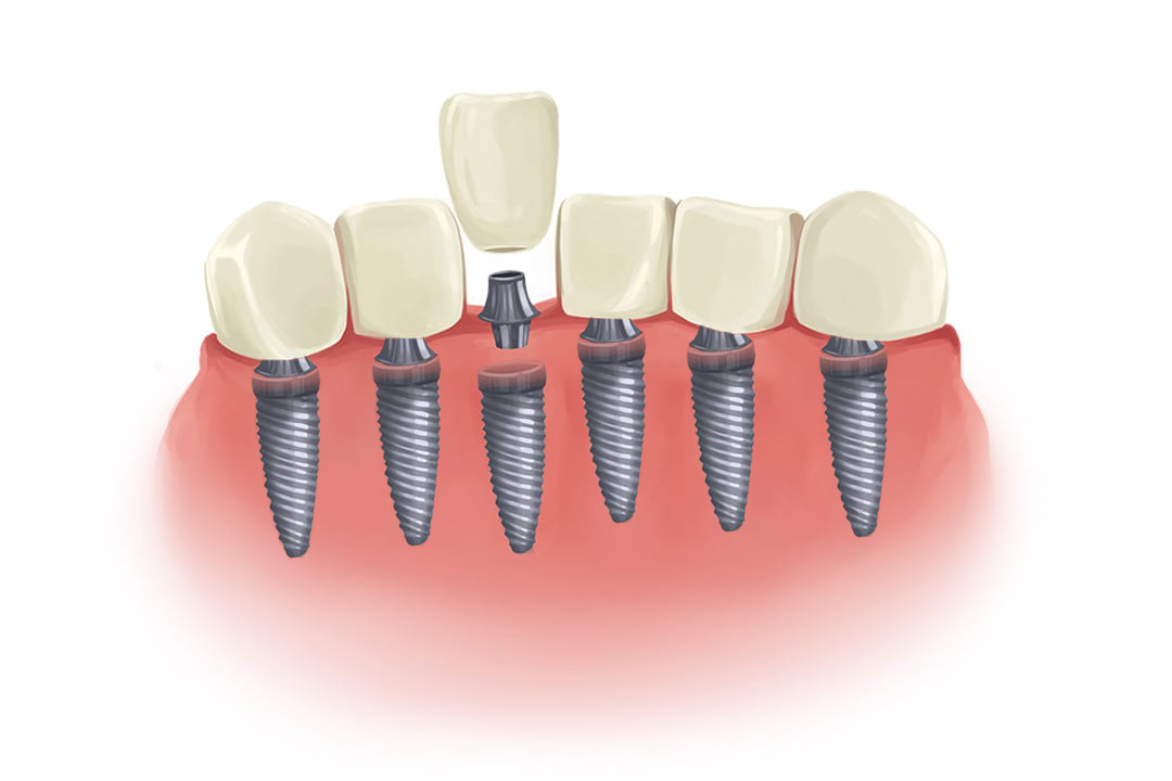 all-tooth-implant Implants for all teeth