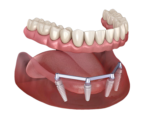 bar-implant-overdentures-new bar implant overdenture
