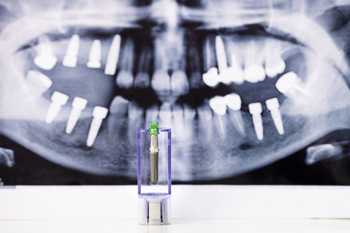 dental implant xray image