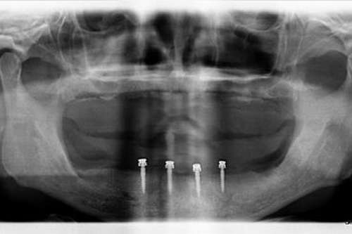 dental implant xray