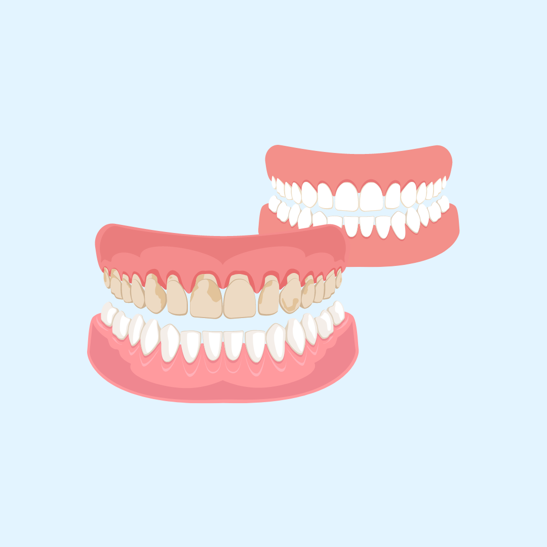 teethwhitening Teeth Whitening - Rec