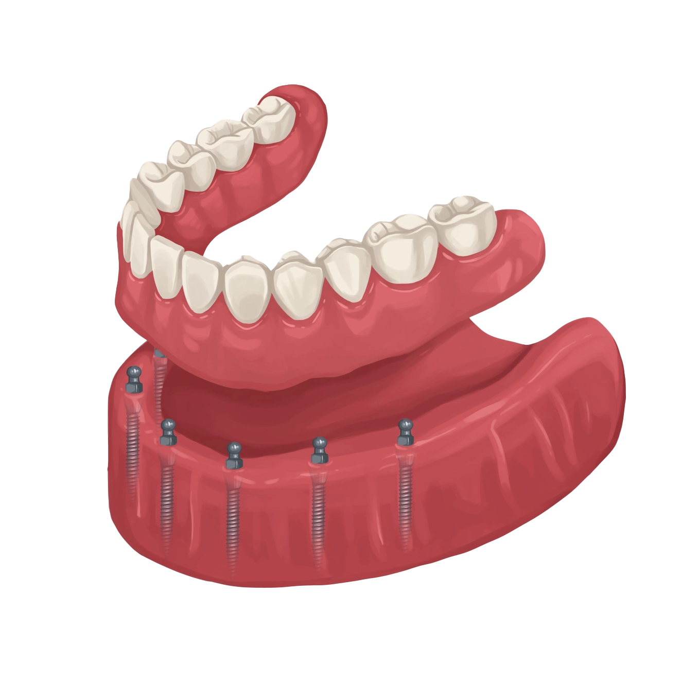 6-mini-dental-implant-denture Single Implant Overdentures