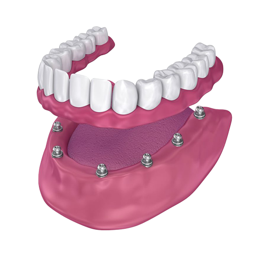 Regular Implant Overdenture Regular Implant Overdenture