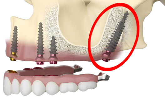 Pterygoid Dental Implant