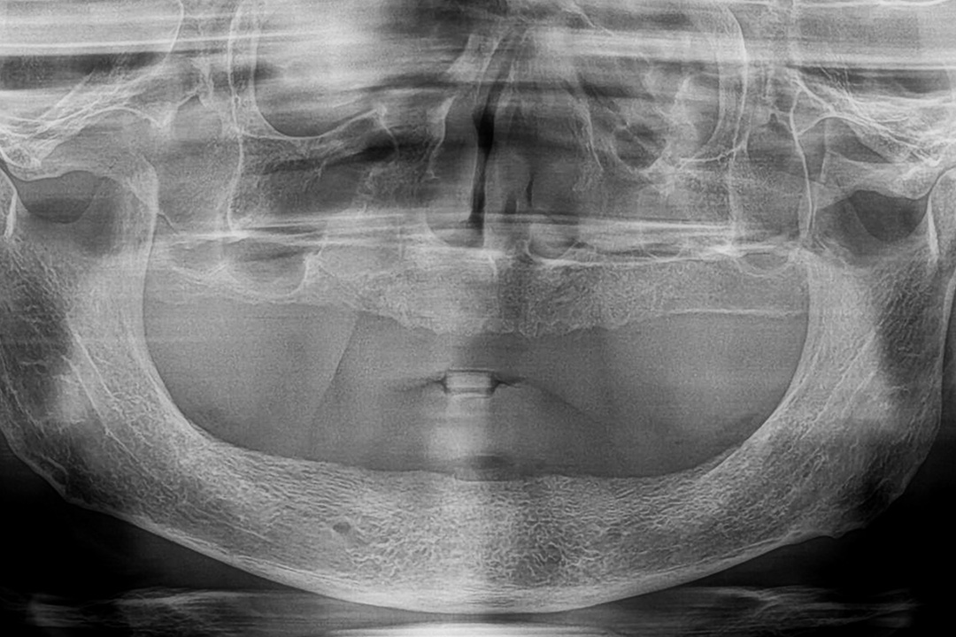 OPG of edentulous patient