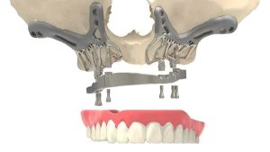 Subperiosteal Dental Implant