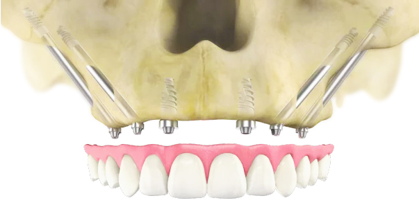 Zygomatic Dental Implants with Bridge
