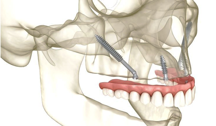 Zygomatic Dental Implants with Bridge