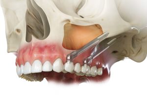 Double Zygomatic Dental Implants with Bridge