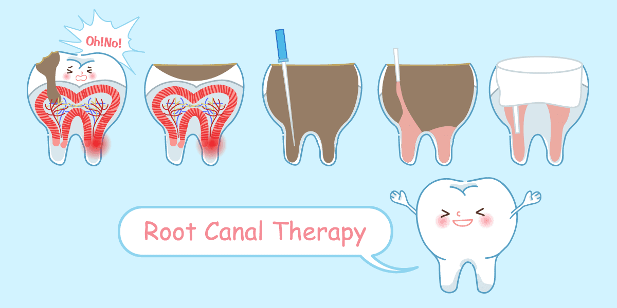ROOT CANAL TREATMENT CARTOON