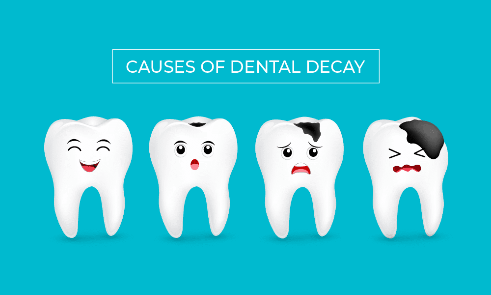 Causes of Dental Decay