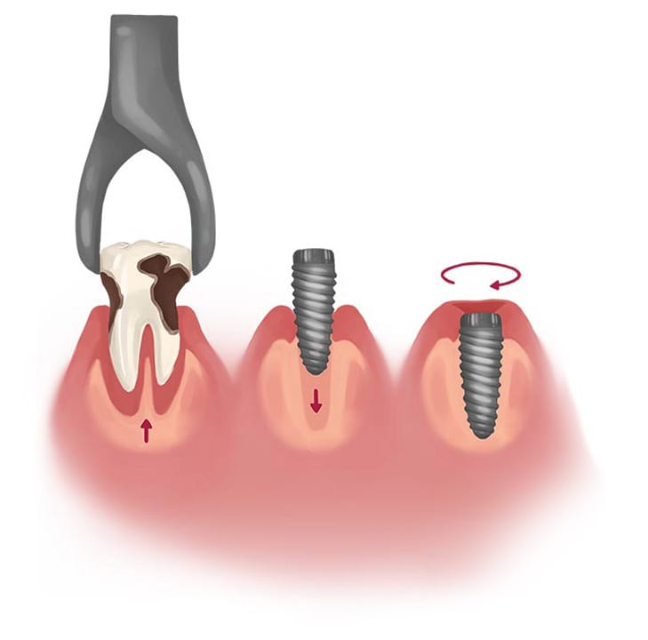 immediate dental implant placement