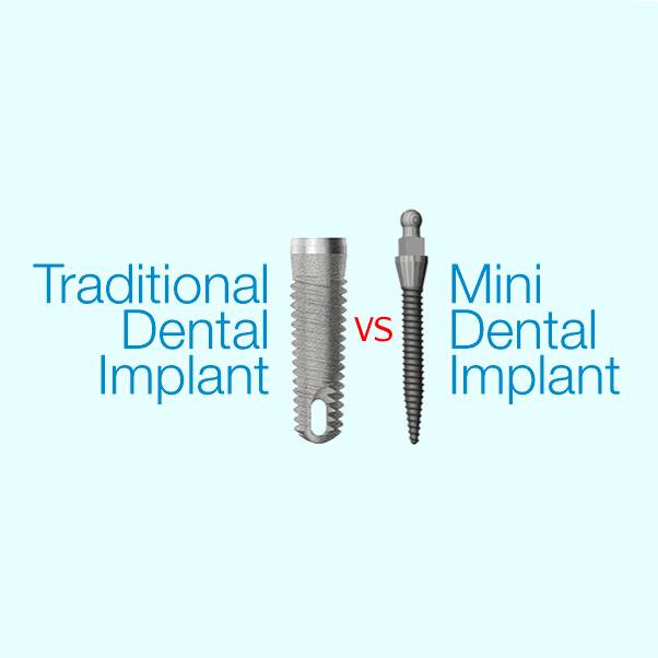 traditional dental implant vs mini dental implant