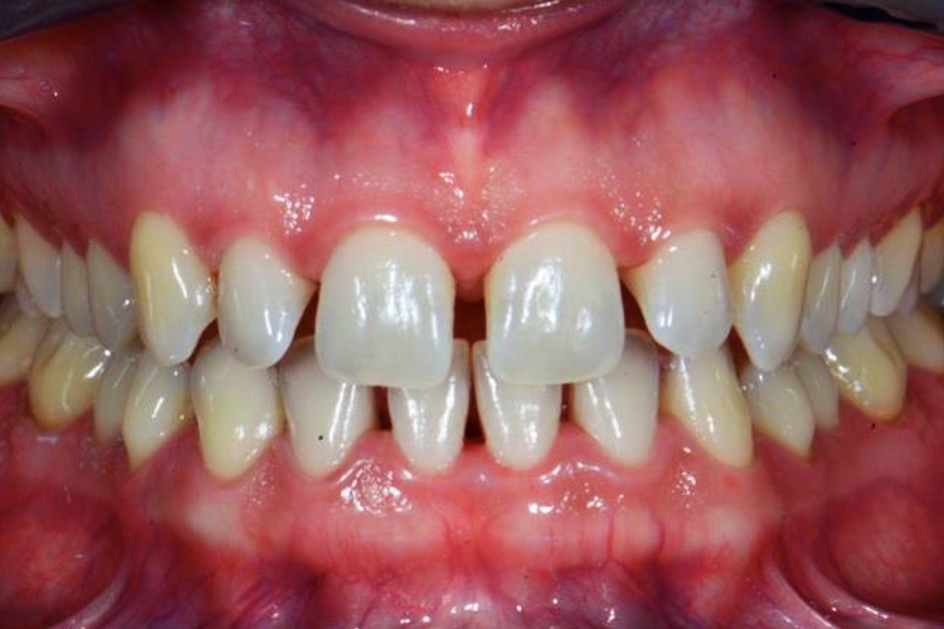 Diastema | Gapped teeth in Singapore | Orthodontic treatment in Singapore