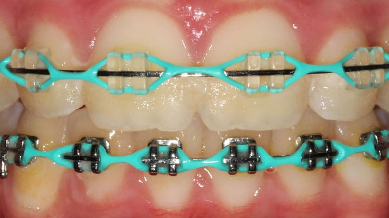 neon blue braces