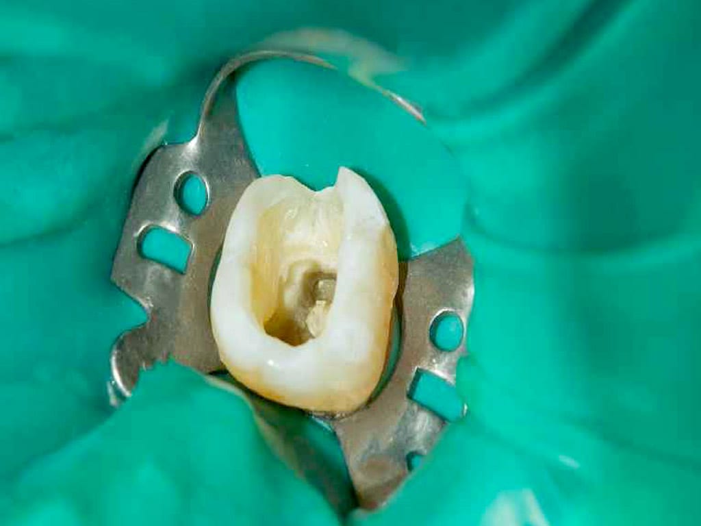 Root canal treatment in Singapore