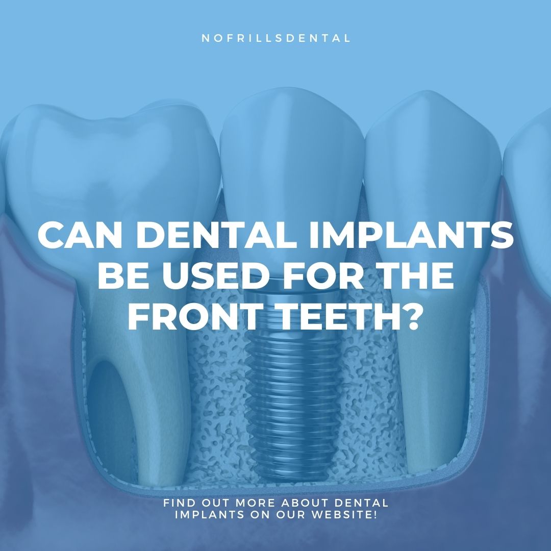 dental implant featured image