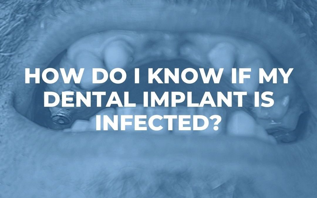 What Happens if a Dental Implant Gets Infected?